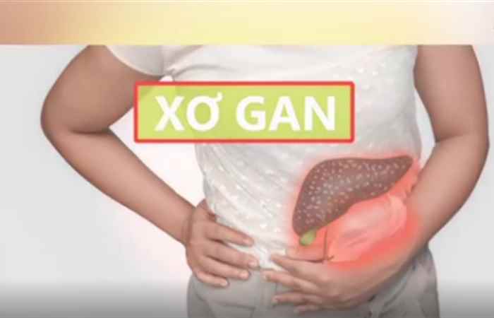 Sống khỏe 360 -  Bệnh xơ gan (03-01-2020)